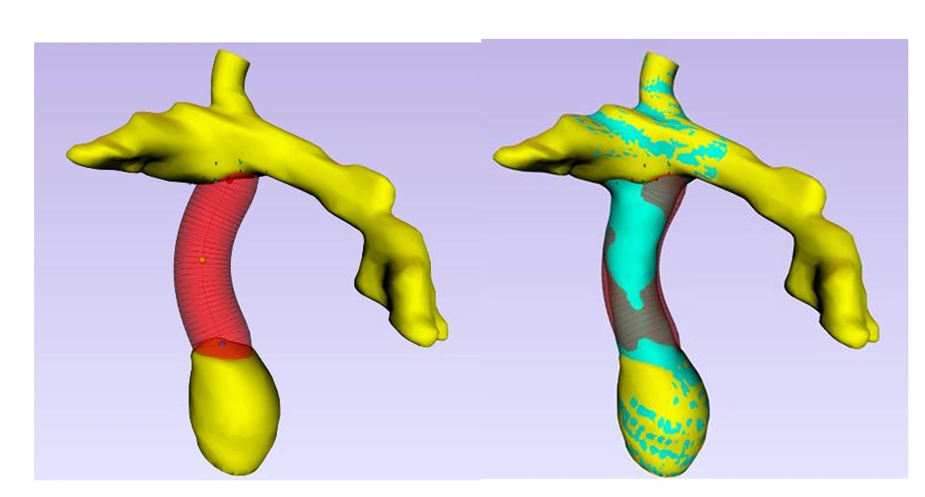 Anatomical models and flow visualization for Fontan surgical planning